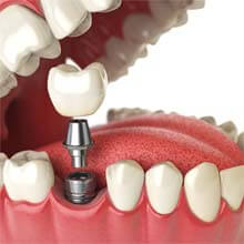 illustration of a single dental implant