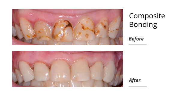 composite bonding before and after