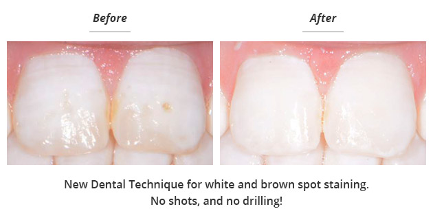 correction of white and brown spot staining