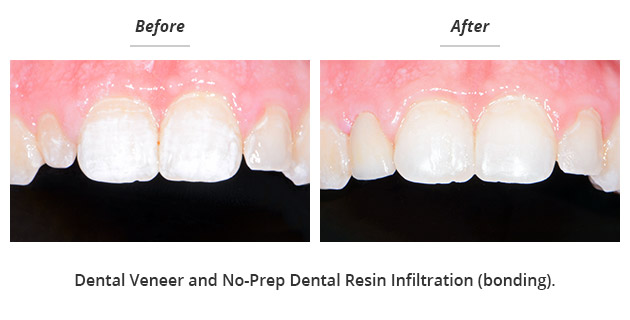 dental veneer and dental resin infiltration